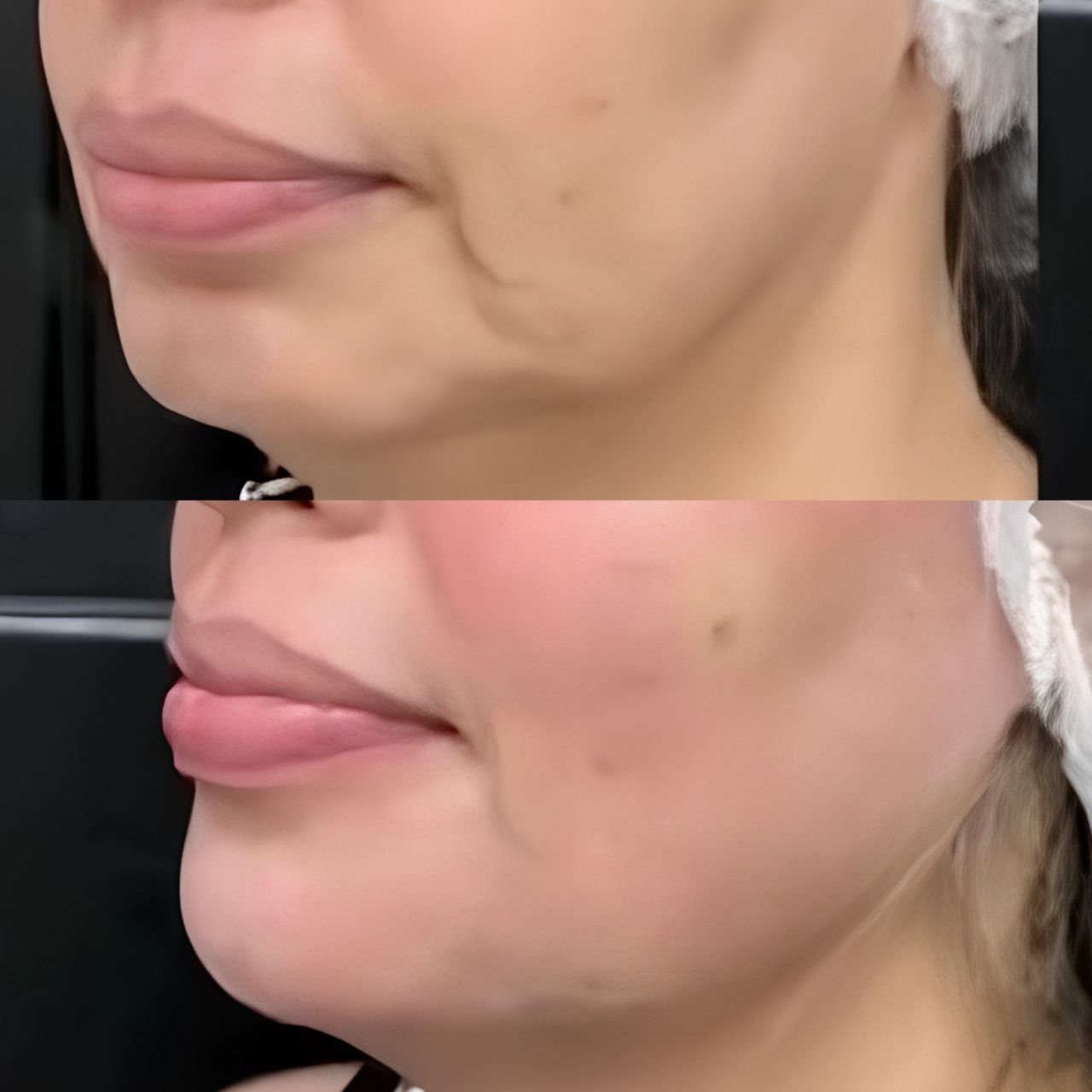antes e depois tratamento com protocolos exclusivos para o resto
