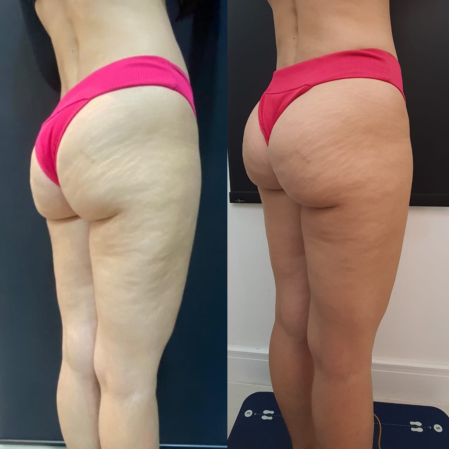 Antes e depois de harmonização glútea com melhora de volume e contorno em vista lateral